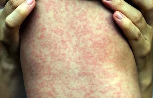 Persiste brote de sarampión en México: OPS