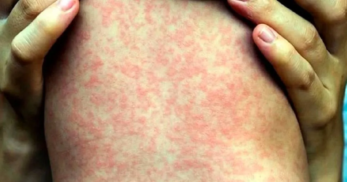 Se explicó que, para conservarla acreditación, el país no debe registrar contagios sostenidos hasta febrero próximo.