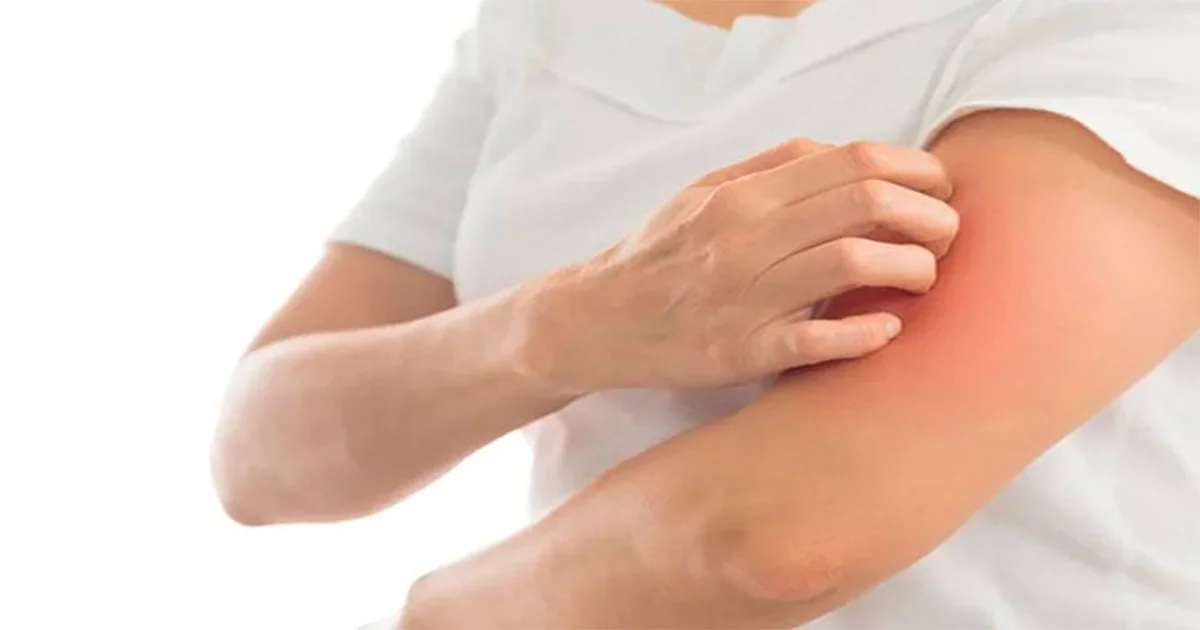 Cofepris indica algunos de los síntomas que pueden tomarse en consideración, y con ello promover su registro.