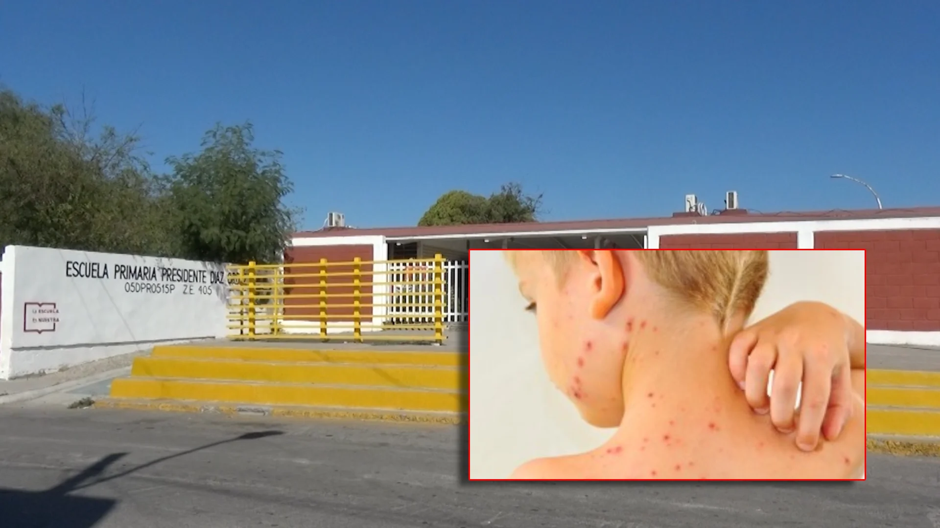 Tomando en cuenta que el comportamiento de la Varicela es muy variable, no se puede precisar la cantidad de días que los menores padezcan la enfermedad