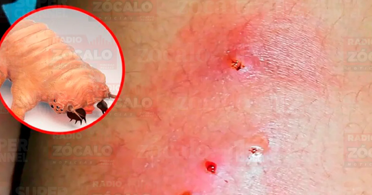 De los 8 casos registrados, 5 son hombres y 3 mujeres, según los informes; asimismo, 4 de estos aún se encuentran hospitalizados.