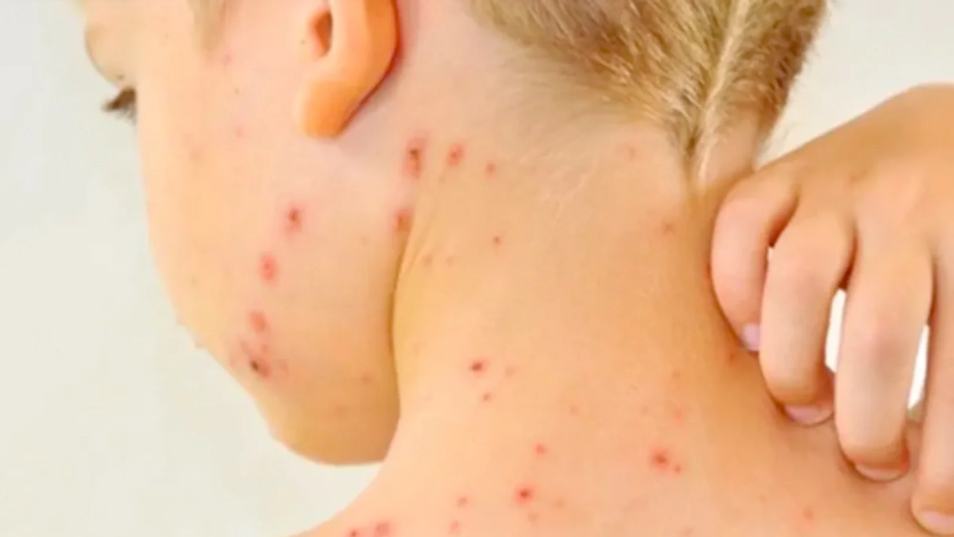 El boletín epidemiológico señala que hay 277 casos activos, los cuales se concentran en su mayoría en Chiapas.