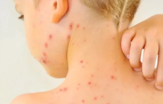 El secretario de Salud, Moisés Nájera detalló que el menor salió de viaje con su familia y al regresar, presentó fiebre durante cinco días.