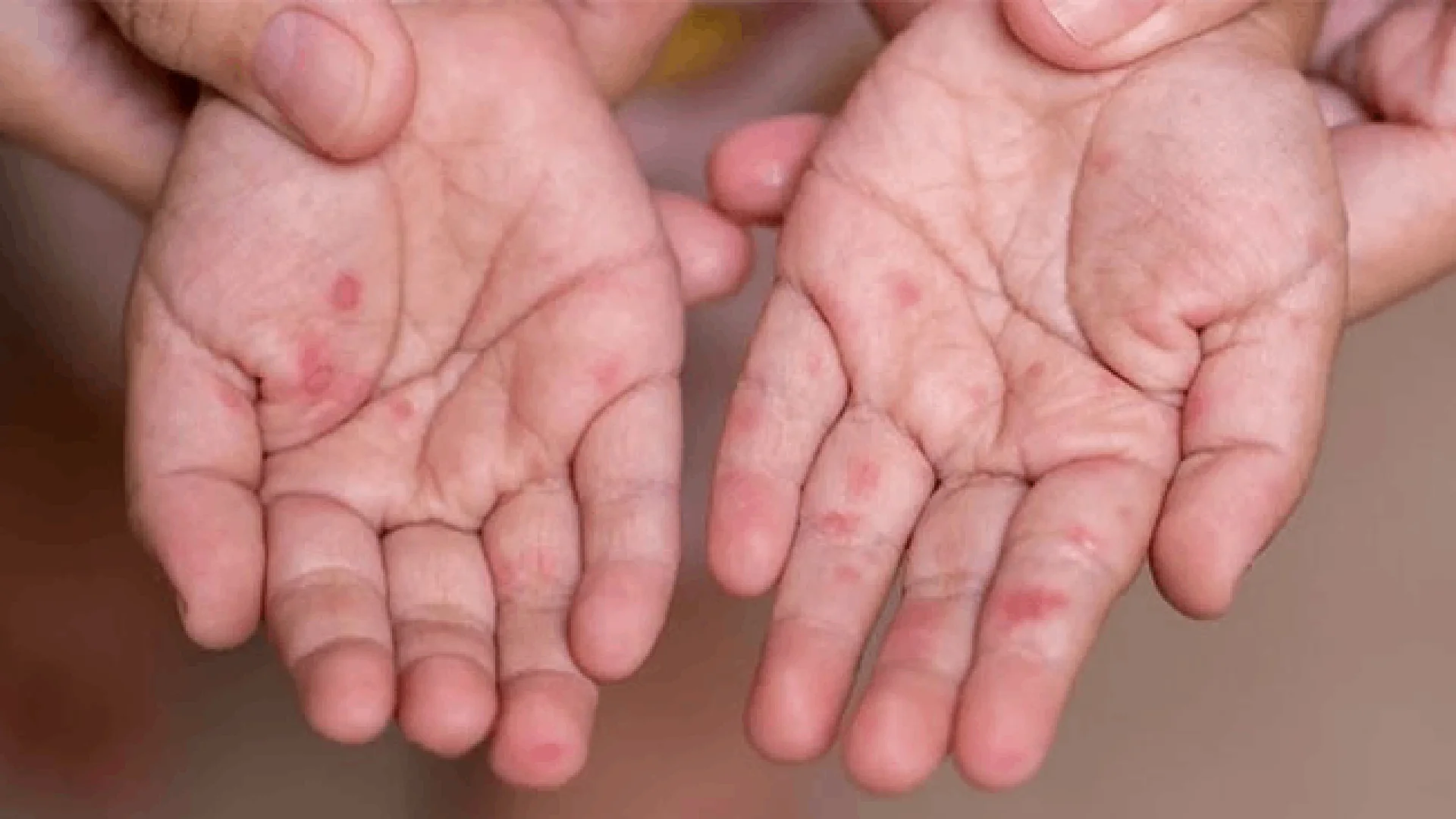 La mayoría de defunciones se han registrado en Chihuahua con 21.