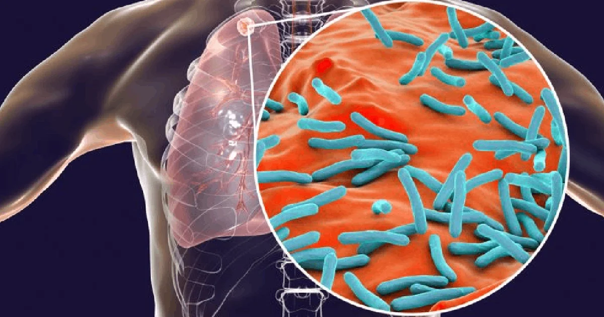 Aumento de casos de tuberculosis en Piedras Negras preocupa a las autoridades. La resistencia a tratamientos y los contactos sospechosos podrían disparar las cifras durante 2026.