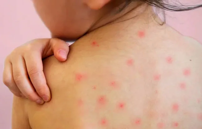 Reportan 151 contagios de sarampión en últimas 48 horas; van más de 14 mil casos en México