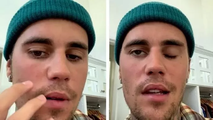 â€˜Este ojo no parpadeaâ€™: Justin Bieber sufre parÃ¡lisis facial y pospone conciertos