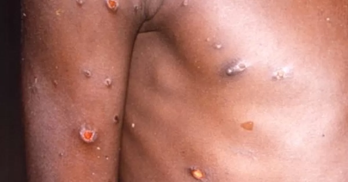 Salud confirma 5 casos de viruela símica en México; estos son los estados donde se ha detectado