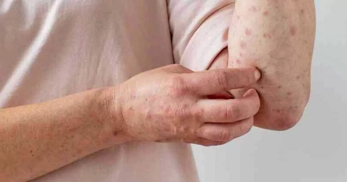 OMS pide más control, comunicación y solidaridad contra viruela del mono