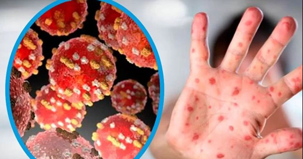 Descarta Gatell propagación extensa de viruela del mono; confirman 60 casos en México