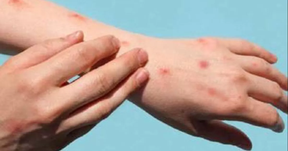 Puebla reporta primeros dos casos de viruela del mono