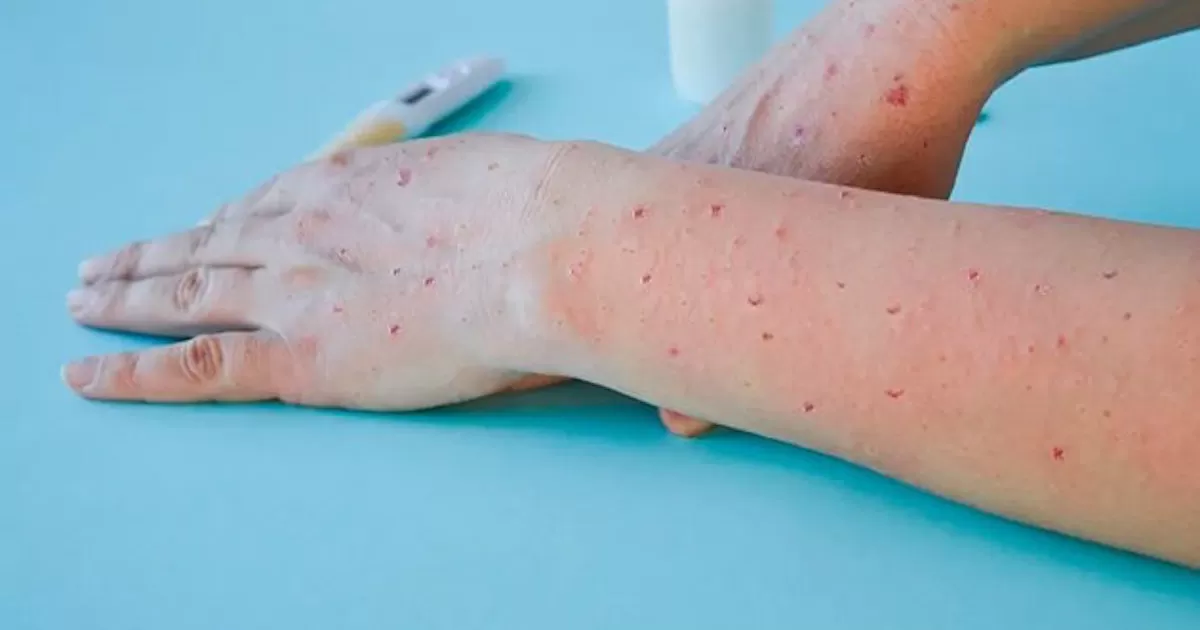 Michoacán detecta su primer caso de viruela del mono; es turista proveniente de CDMX