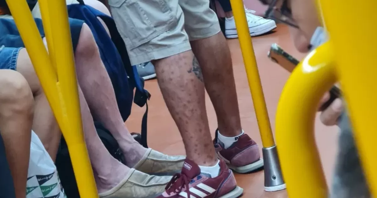 Hombre con viruela del mono es captado en un tren de Madrid, y declina el retirarse