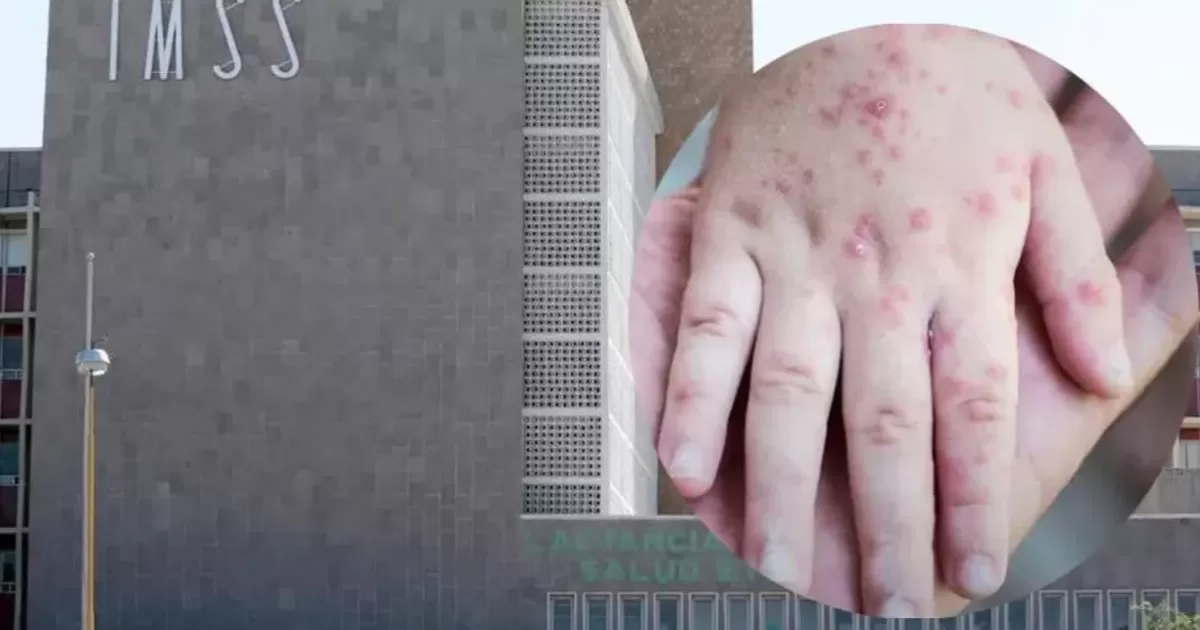IMSS revisa caso sospechoso de viruela de mono en Torreón