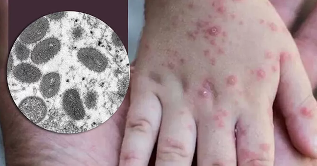 En estudio segundo caso sospechoso de viruela del mono en Coahuila