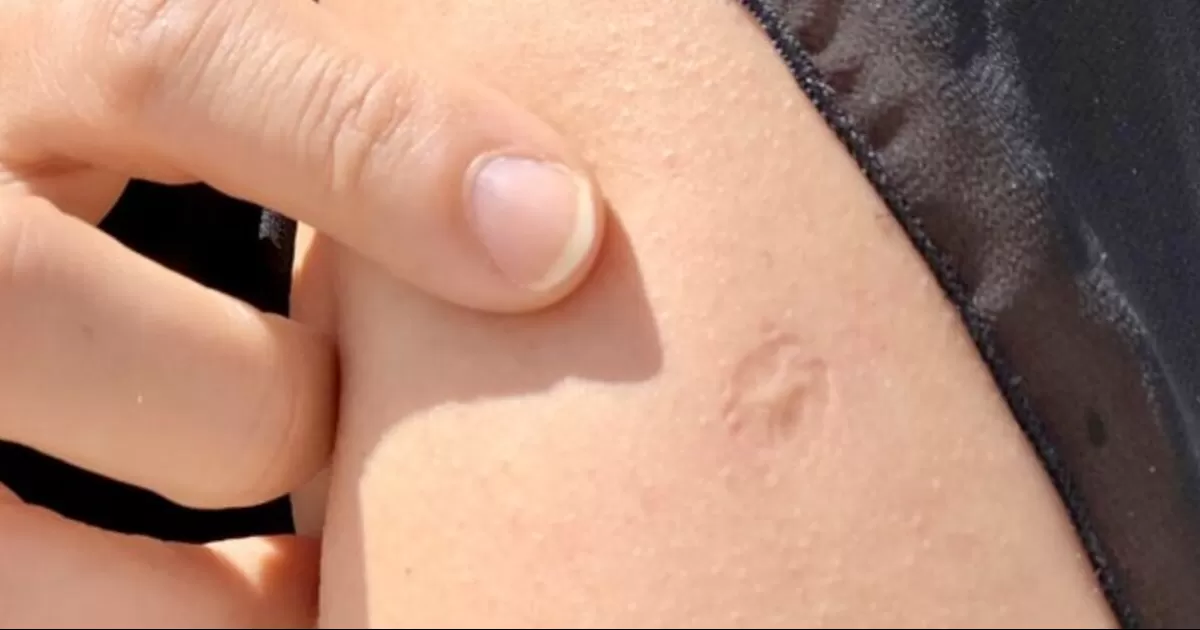 Podrás ser inmune a "viruela del mono" si tienes esta cicatriz en el brazo