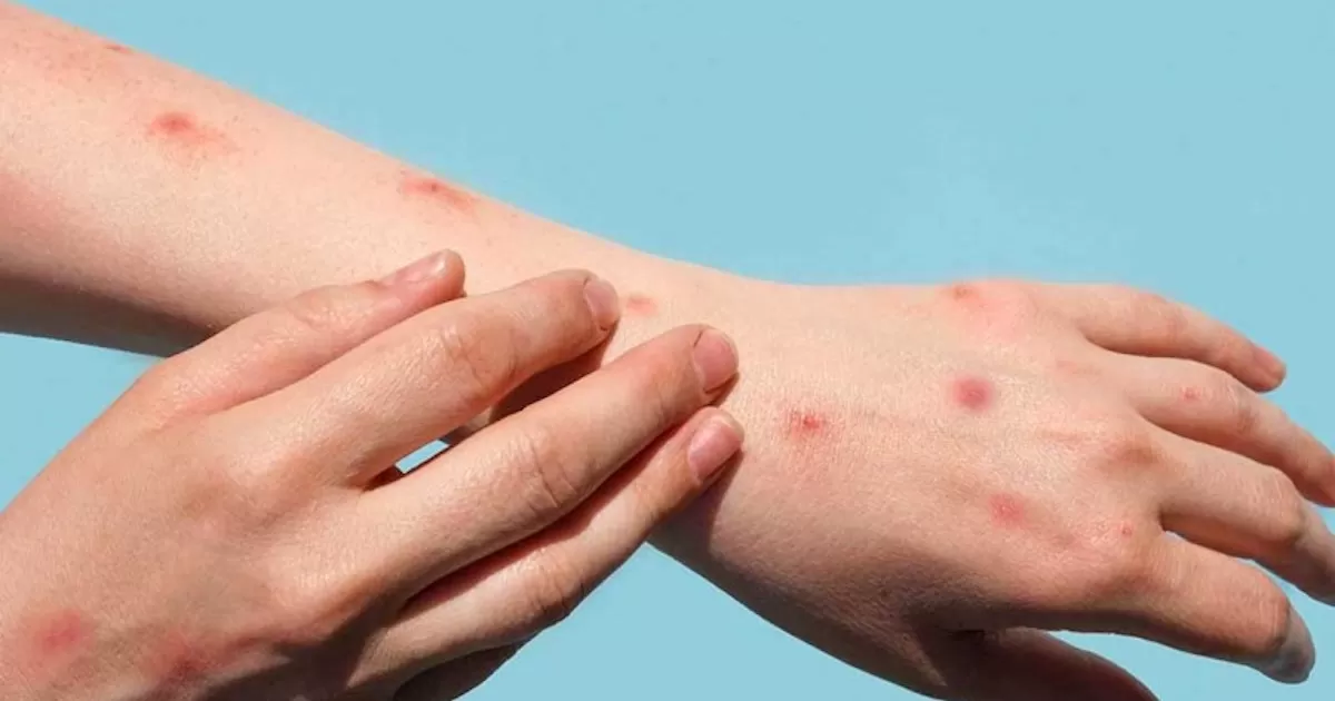 Incrementa un 70% contagios de viruela del mono en el país: UAQ