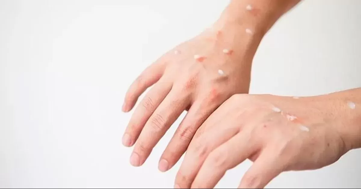 Posible caso de viruela del mono en Acuña: una migrante está en observación