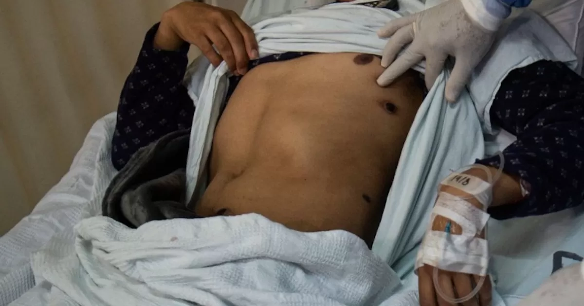 Hombre da positivo a viruela del mono, covid-19 y VIH