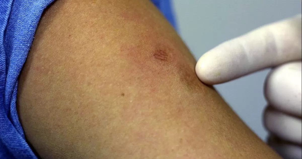 En la última semana se han confirmado 3,400 nuevos casos de viruela del mono, de los más de 58,000 diagnosticados afectados a la fecha.