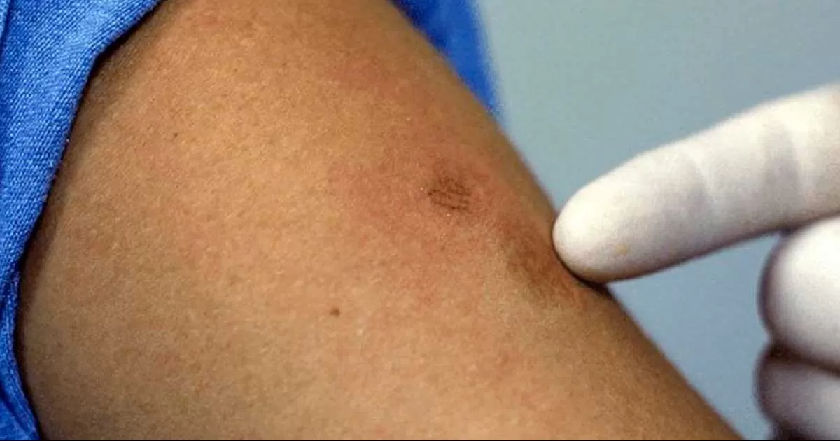 Detectan octavo contagio de viruela del mono en Coahuila; confirman primer caso en Nueva Rosita