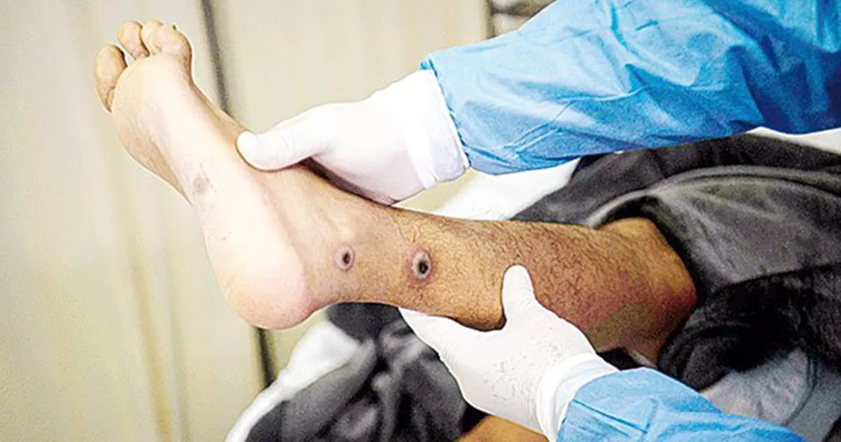 Extrema Salud control por viruela símica