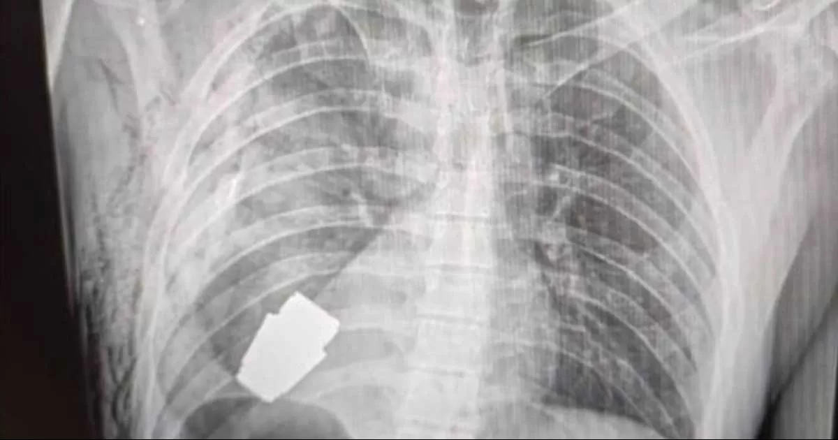 Cirujanos extraen granada sin detonar alojada en el pecho de un soldado ucraniano