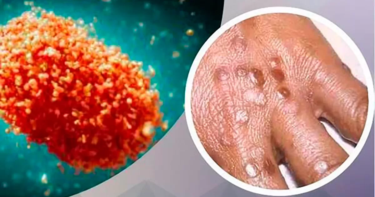 Urgen a México acceso a vacuna contra viruela símica