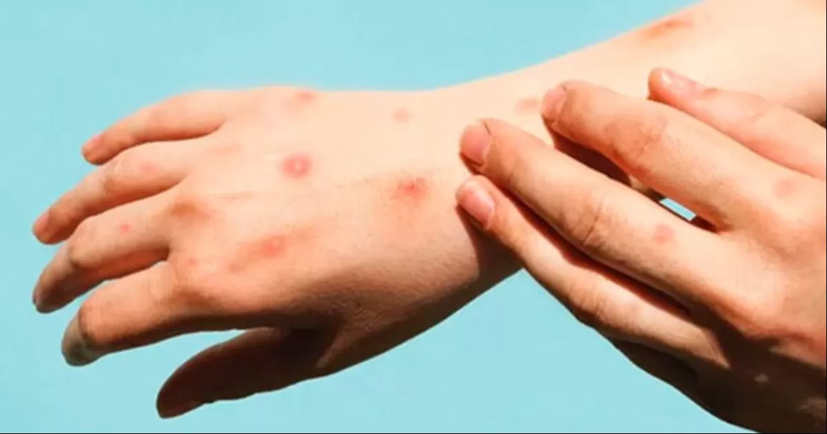 Registra Portugal un nuevo brote de viruela del mono, con 37 casos en el último mes