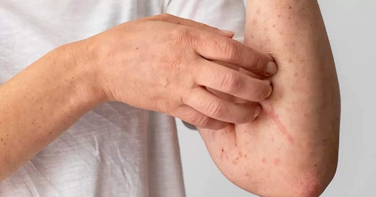 Secretaría de Salud vigila 12 municipios por casos de lepra