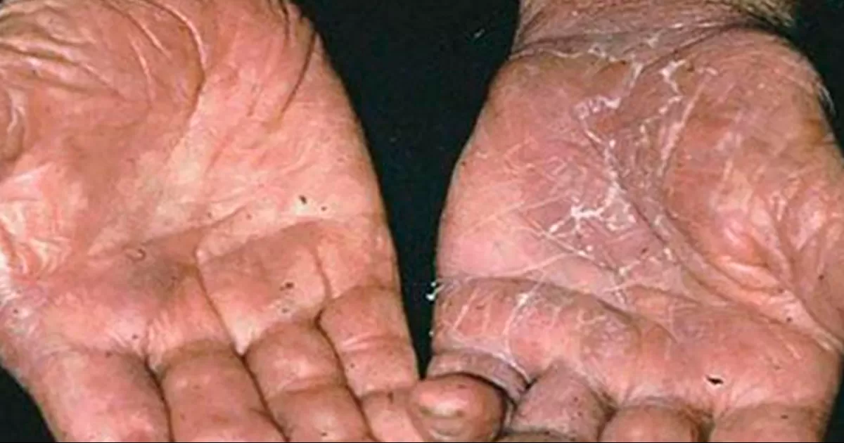 Una de las características es que aparecen úlceras en la piel que de no tratarse a tiempo pueden causar la desfiguración grave en los pacientes.