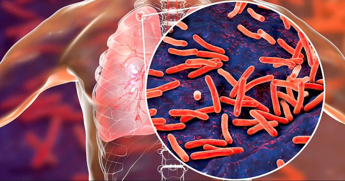 Esta alza en los casos se puede asociar al hecho que, al haber un mayor consumo de drogas en las calles, quienes las consumen ven disminuido su sistema inmunológico y por lo tanto son más vulnerables a adquirir la enfermedad: Epidemióloga jurisdiccional.