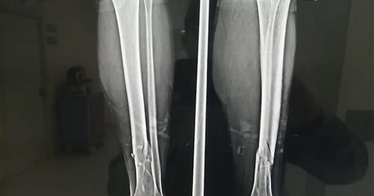 El lesionado Juan Antonio Terrazas sufrió fractura de pómulo y pierna al recibir el ataque por parte de un supuesto "pollero", quien también lo amenazó de muerte.