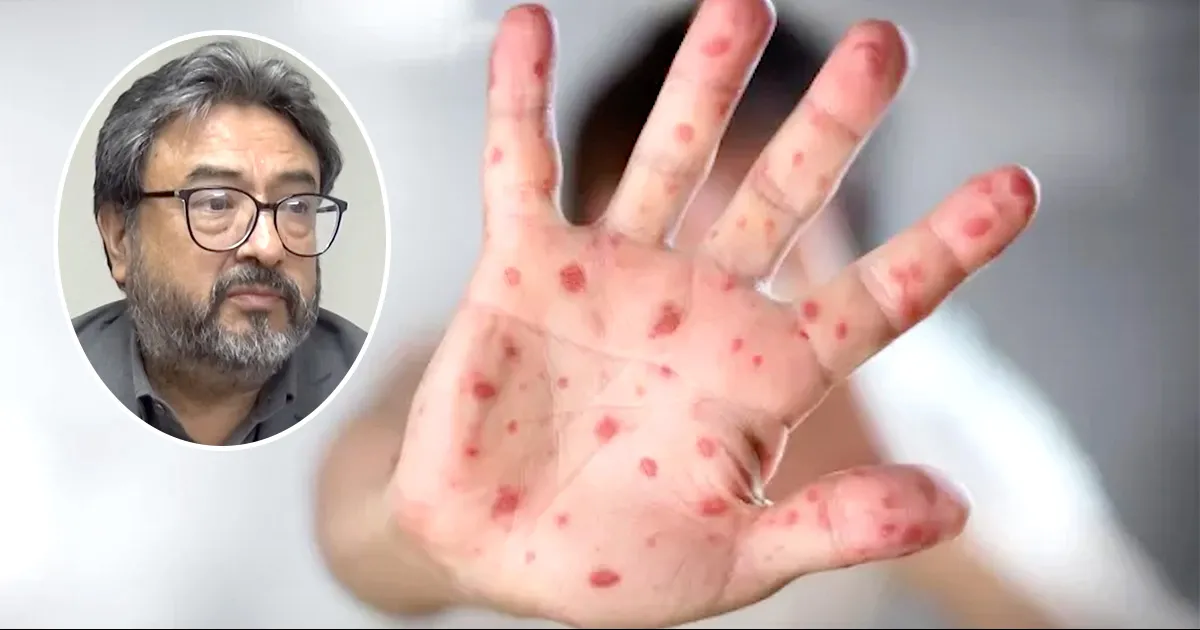 El doctor Garibaldi Zapatero dijo que de esa manera el diagnóstico fue en el sentido de padecer una Dermatosis o enfermedad de la piel debido a varios factores de riesgo.