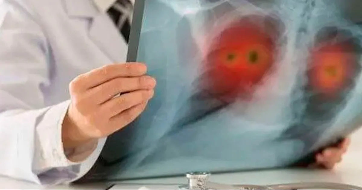 OMS alerta sobre medicamento falsificado para tratar cáncer de pulmón no microcítico