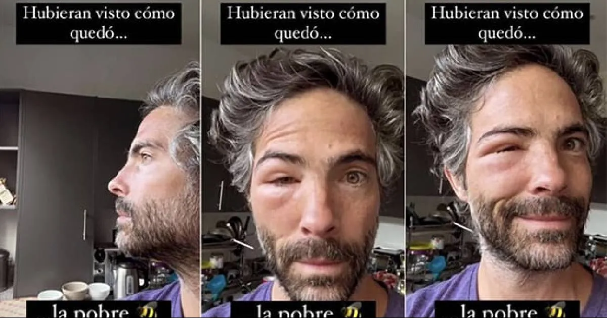 Osvaldo Benavides muestra como queda el rostro después de una picadura de abeja