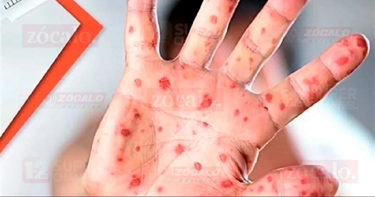 Hasta el momento se han confirmado mil 582 casos, según el último reporte de la Secretaría de Salud