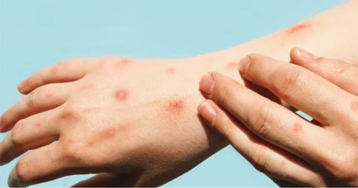 Se mantienen determinadas recomendaciones para la prevención de esta enfermedad al menos hasta agosto de 2026